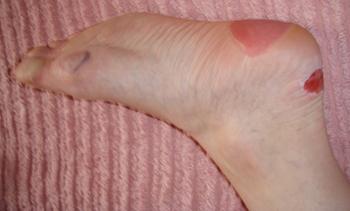 blister on the back of my heel
